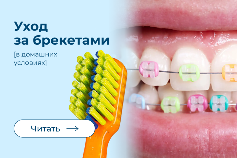 Домашний уход после установки брекетов
