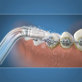 Ортодонтические насадки для ирригаторов WaterPik OD-100E (2 шт) Ортодонтические насадки для ирригаторов WaterPik OD-100E (2 шт)