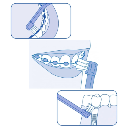 Зубная щетка CURAPROX 708 для имплантов и ортоконструкций (CS 708) ЖЕЛТАЯ Зубная щетка CURAPROX 708 для имплантов и ортоконструкций (CS 708) ЖЕЛТАЯ